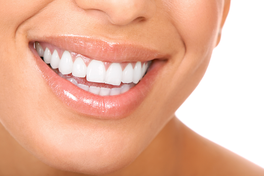 White Tooth Fillings and Dental Bonding for Cavities