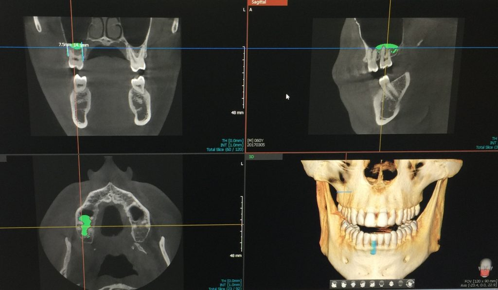 CBCT dental scan for accurate dental surgery planning