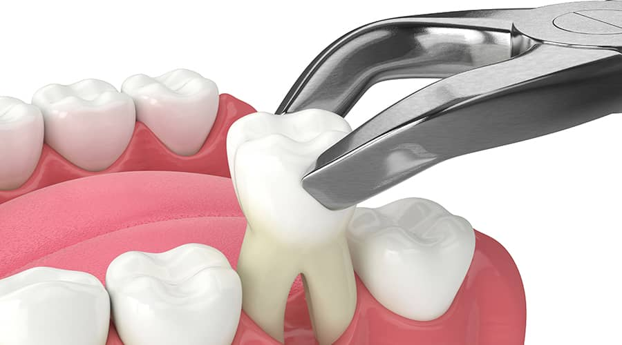Easy tooth removal using a dental tool during dental surgery