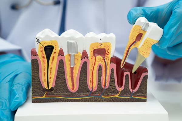 Root Canal Vs  Extraction: Make The Right Choice For Your Oral Health